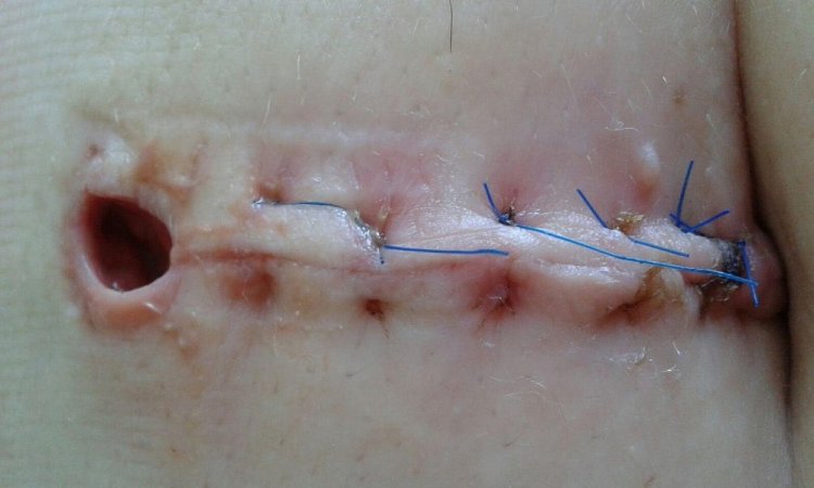 Ostéopathe pour le traitement des cicatrices à Coustellet -Maubec